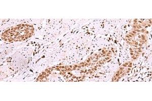 Immunohistochemistry of paraffin-embedded Human esophagus cancer tissue using ISL2 Polyclonal Antibody at dilution of 1:40(x200) (ISL2 抗体)