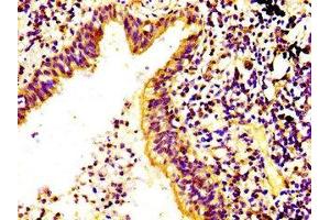 IHC image of ABIN7168192 diluted at 1:400 and staining in paraffin-embedded human lung cancer performed on a Leica BondTM system. (RPS6KA6 抗体  (AA 340-467))