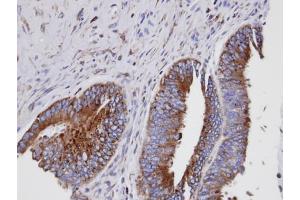 IHC-P Image Immunohistochemical analysis of paraffin-embedded human mixed ovarian cancer, using GIT1, antibody at 1:100 dilution. (GIT1 抗体  (Internal Region))