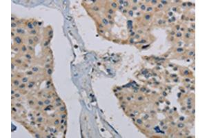 The image on the left is immunohistochemistry of paraffin-embedded Human prostate cancer tissue using ABIN7191867(PHKG1 Antibody) at dilution 1/20, on the right is treated with synthetic peptide. (PHKG1 抗体)