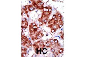 Formalin-fixed and paraffin-embedded human hepatocellular carcinoma tissue reacted with CPT1B polyclonal antibody  , which was peroxidase-conjugated to the secondary antibody, followed by DAB staining . (CPT1B 抗体  (C-Term))