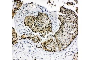 IHC-P: HOXA4 antibody testing of human breast cancer tissue (HOXA4 抗体  (N-Term))