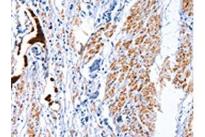 The image on the left is immunohistochemistry of paraffin-embedded Human prostate cancer tissue using ABIN7128792(CATSPER1 Antibody) at dilution 1/40, on the right is treated with fusion protein.