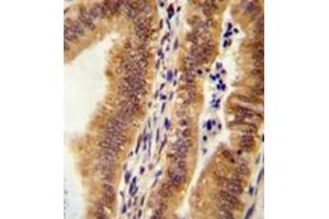 Immunohistochemistry analysis in formalin fixed and paraffin embedded human uterus tissue reacted with KIAA1609 Antibody (C-term) followed which was peroxidase conjugated to the secondary antibody and followed by AB staining. (KIAA1609 抗体  (C-Term))