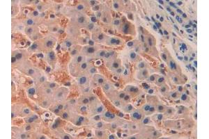 IHC-P analysis of Human Liver cancer Tissue, with DAB staining. (SIGLEC12 抗体  (AA 22-218))