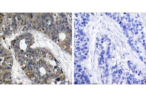 Peptide - +Immunohistochemical analysis of paraffin-embedded human breast carcinoma tissue using HSP27 (Ab-82) (Ab-232) antibody (#B7112). (HSP27 抗体  (pSer82))