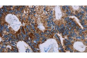 Immunohistochemistry of paraffin-embedded Human colon cancer using JAM-A Polyclonal Antibody at dilution of 1:40 (F11R 抗体)