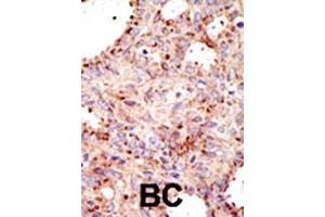 Formalin-fixed and paraffin-embedded human cancer tissue reacted with the primary antibody, which was peroxidase-conjugated to the secondary antibody, followed by AEC staining. (ARFGAP1 抗体  (C-Term))