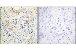 Immunohistochemistry analysis of paraffin-embedded human prostate carcinoma tissue, using TM16G Antibody. (Anoctamin 7 抗体  (AA 881-930))