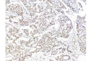 ABIN7094711 and ABIN7098762 at 1/100 staining Human breast cancer by IHC-P. (Histone H1.5 抗体  (N-Term))