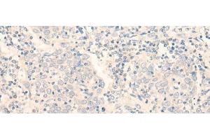 Immunohistochemistry of paraffin-embedded Human cervical cancer tissue using ADGRE3 Polyclonal Antibody at dilution of 1:35(x200) (EMR3 抗体)