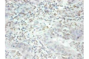 Immunohistochemical of paraffin-embedded human breast cancer tissue using ABIN7159679 at dilution of 1:200 (MFGE8 抗体)