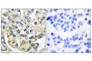 Immunohistochemical analysis of paraffin-embedded human breast carcinoma tissue using FGFR2 antibody. (FGFR2 抗体  (Internal Region))