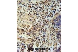 ZN Antibody (Center) (ABIN654974 and ABIN2844614) immunohistochemistry analysis in formalin fixed and paraffin embedded human lung carcinoma followed by peroxidase conjugation of the secondary antibody and DAB staining. (ZNF720 抗体  (AA 34-62))