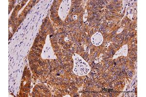 Immunoperoxidase of monoclonal antibody to KIT on formalin-fixed paraffin-embedded human stomach carcinoma. (KIT 抗体  (AA 41-140))