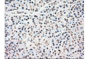 Immunohistochemical staining of paraffin-embedded colon tissue using anti-CHEK2mouse monoclonal antibody. (CHEK2 抗体)