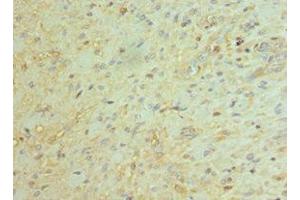 Immunohistochemistry of paraffin-embedded human glioma using ABIN7145171 at dilution of 1:100 (BCL11A 抗体  (AA 1-230))