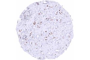 Prostatic adenocarcinoma Gleason 336 with moderate to strong MCM2 staining of a significant fraction of tumor cells (Recombinant MCM2 抗体)