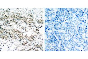 P-Peptide - +Immunohistochemical analysis of paraffin- embedded human breast carcinoma tissue using AFX (phospho-Ser197) antibody. (FOXO4 抗体  (pSer197))