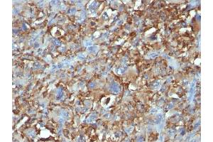Formalin-fixed, paraffin-embedded human Histiocytoma stained with CD68 Mouse Monoclonal Antibody (C68/684). (CD68 抗体)