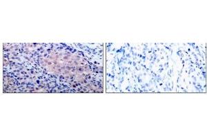 Immunohistochemical analysis of paraffin-embedded human breast carcinoma tissue using IκB-α (Ab- 32/36) antibody (E021122). (NFKBIA 抗体)