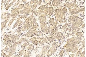 Immunohistochemical analysis of paraffin-embedded Human Breast cancer section using Pink1 (ABIN6243595 and ABIN6577086). (ErbB2/Her2 抗体  (AA 102-339))