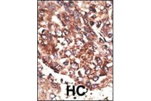 Formalin-fixed and paraffin-embedded human cancer tissue reacted with the primary antibody, which was peroxidase-conjugated to the secondary antibody, followed by AEC staining. (MMP13 抗体  (C-Term))
