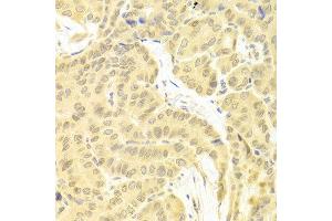 Immunohistochemistry of paraffin-embedded human thyroid cancer using CFLAR antibody at dilution of 1:100 (x400 lens). (FLIP 抗体)