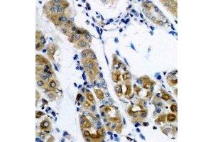 Immunohistochemical analysis of SerRS staining in human gastric cancer formalin fixed paraffin embedded tissue section. (Seryl-tRNA Synthetase (SARS) 抗体)
