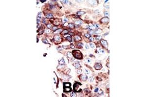 Formalin-fixed and paraffin-embedded human cancer tissue reacted with the primary antibody, which was peroxidase-conjugated to the secondary antibody, followed by DAB staining. (AXL 抗体  (C-Term))