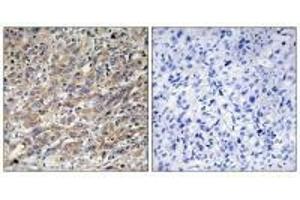 Immunohistochemistry analysis of paraffin-embedded human liver carcinoma tissue using COX17 antibody. (COX17 抗体  (N-Term))