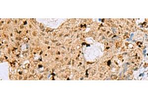 Immunohistochemistry of paraffin-embedded Human ovarian cancer tissue using MAF Polyclonal Antibody at dilution of 1:25(x200) (MAF 抗体)