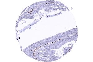 Colorectal adenocarcinoma with a complete loss of MRE11 staining in tumor cells (Recombinant Mre11 抗体)