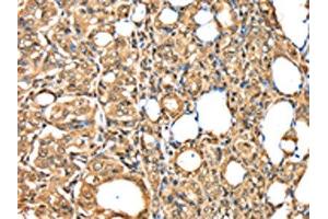 The image on the left is immunohistochemistry of paraffin-embedded Human thyroid cancer tissue using ABIN7192036(PSMB8 Antibody) at dilution 1/30, on the right is treated with synthetic peptide. (PSMB8 抗体)