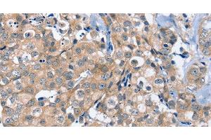 Immunohistochemistry of paraffin-embedded Human breast cancer using OTUB1 Polyclonal Antibody at dilution of 1:40 (OTUB1 抗体)