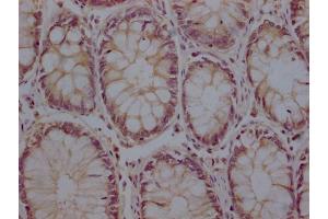 IHC image of ABIN7176722 diluted at 1:200 and staining in paraffin-embedded human colon cancer performed on a Leica BondTM system. (ZP2 抗体  (AA 440-716))