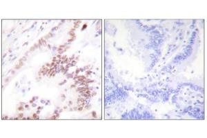 Immunohistochemistry analysis of paraffin-embedded human lung carcinoma tissue, using p300 antibody. (p300 抗体  (N-Term))