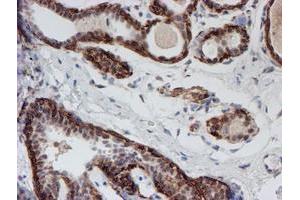 Immunohistochemical staining of paraffin-embedded Human breast tissue using anti-ATRIP mouse monoclonal antibody. (ATRIP 抗体  (AA 42-309))
