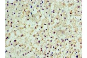 Immunohistochemistry of paraffin-embedded human liver cancer using ABIN7147368 at dilution of 1:100 (CENPQ 抗体  (AA 131-268))