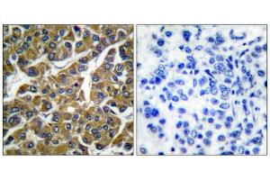 Immunohistochemical analysis of paraffin-embedded human breast carcinoma tissue, using MMP3 antibody (ABIN5976463). (MMP3 抗体  (C-Term))