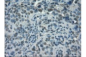 Immunohistochemical staining of paraffin-embedded Carcinoma of bladder tissue using anti-STAT1mouse monoclonal antibody. (STAT1 抗体)