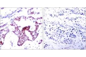 Immunohistochemistry analysis of paraffin-embedded human breast carcinoma, using NF-kappaB p65 (Phospho-Ser276) Antibody. (NF-kB p65 抗体  (pSer276))