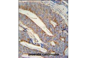 DACT1 antibody immunohistochemistry analysis in formalin fixed and paraffin embedded human prostate carcinoma followed by peroxidase conjugation of the secondary antibody and DAB staining.