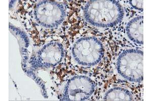 Immunohistochemical staining of paraffin-embedded Carcinoma of Human lung tissue using anti-ARHGAP25 mouse monoclonal antibody. (ARHGAP25 抗体)