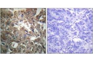 Immunohistochemistry analysis of paraffin-embedded human breast carcinoma tissue, using XPA Antibody. (PA (AA 211-260) 抗体)