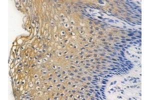 ABIN6255524 and ABIN6267296 at 1/100 staining human cervical carcinoma by IHC-P.