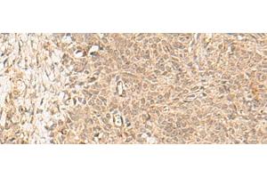 Immunohistochemistry of paraffin-embedded Human ovarian cancer tissue using FBXL4 Polyclonal Antibody at dilution of 1:25(x200) (FBXL4 抗体)