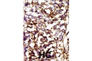 Formalin-fixed and paraffin-embedded human hepatocellular carcinoma tissue reacted with CDK4 polyclonal antibody  , which was peroxidase-conjugated to the secondary antibody, followed by AEC staining. (CDK4 抗体  (AA 273-305))