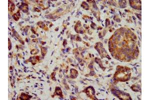 IHC image of ABIN7156494 diluted at 1:400 and staining in paraffin-embedded human pancreatic cancer performed on a Leica BondTM system. (ITGB6 抗体  (AA 451-586))