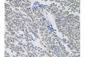Immunohistochemistry of paraffin-embedded human lung cancer using PAX3 antibody (ABIN6290725) at dilution of 1:100 (40x lens). (Paired Box 3 抗体)
